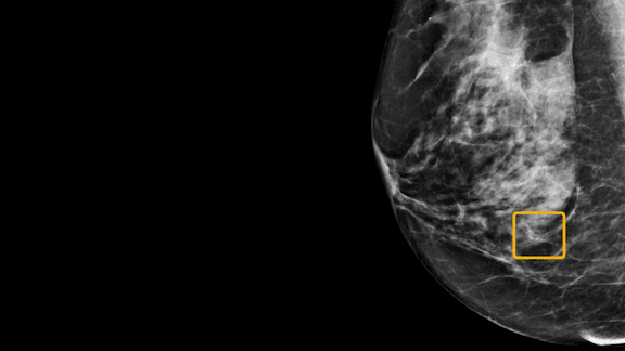 Breast cancer screening