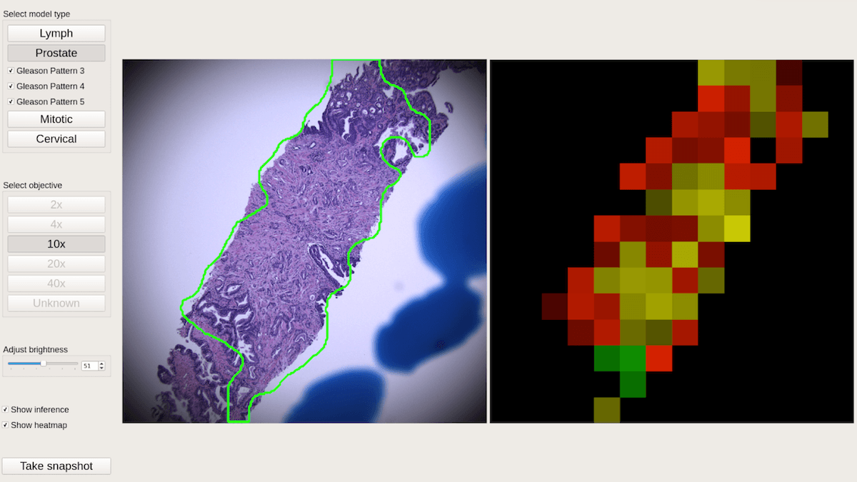 Sharper Vision for Cancer: An AI-powered microscope that helps pathologists detect cancer