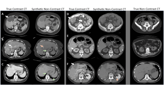 More Data for Medical AI: AI recognizes medical scans without iodine dye.