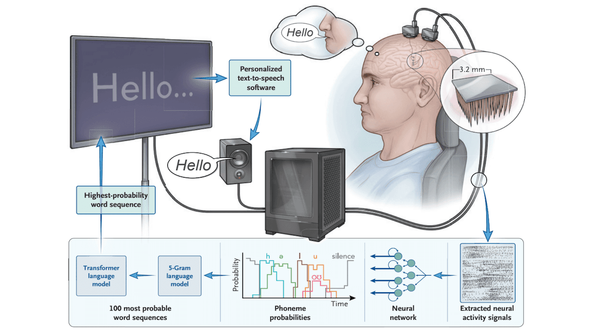 A Lost Voice Regained: Brain implants paired with neural network reconstruct speech for ALS patient