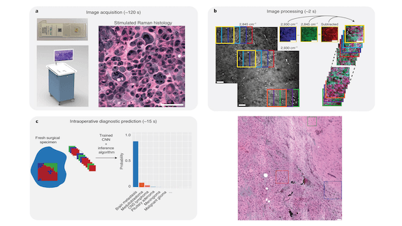 Surgical Speed-Up: An AI tool for diagnosing brain tumor scans