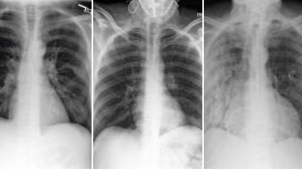 AI Sees Race in X-Rays
