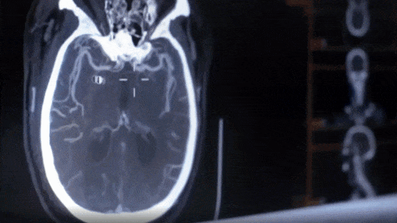 Insurance Coverage for AI: Medicare covers AI stroke detection.